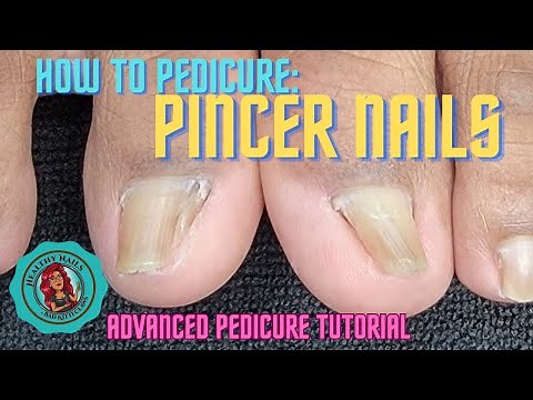 How To: Advanced Pedicure for Pincer Nails