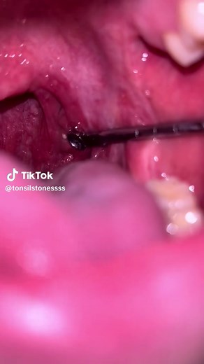 Nice #tonsilstones #tonsilstonesremoval #tonsils #tonsillitis #fyp #foryo