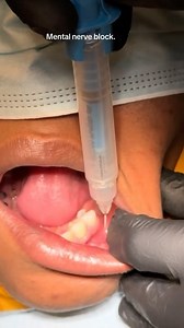 Dr. Abdul Dalghous on Instagram: "Mental nerve block anaesthesia."