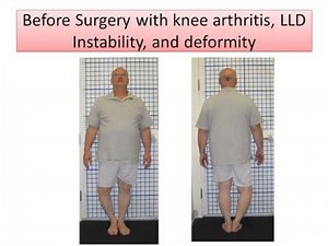 Bowleg Deformity with Advanced Arthritis Treated with Knee Replacement