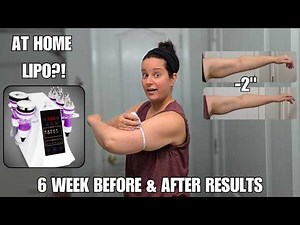 Arm Before & After | At-Home Body Sculpting Machine Review (5-in-1 Cavitation RF) | Mychway