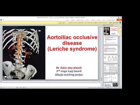 Leriche syndrome