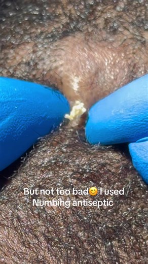 Amazing ingrown hair extraction. Finally some relief.#ingrownhairtreatment #extractions #ingrownhair #razorbumpsolutions #razorbump