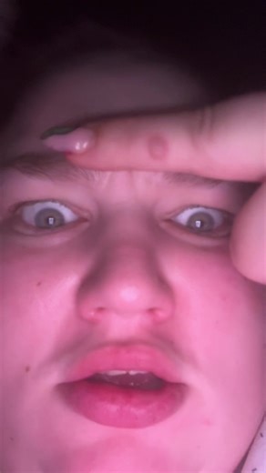 Understanding Pustules: Causes and Treatments