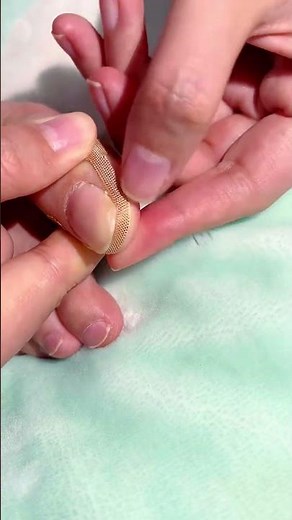 ✅ Effective toenail care for foot pain ( # 2553 ) - Toe Nail Support Pad