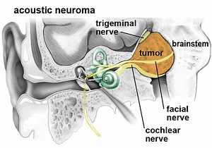 Acoustic Neuroma - Causes, Symptoms, Diagnosis, Treatment