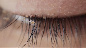 Doctors warn about lice infestations in eyelash extensions