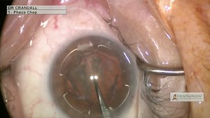 New Pupil Expander Used for Capsular Bag Support - Eyetube