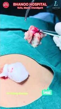 Sebaceous Cyst- how it should be removed