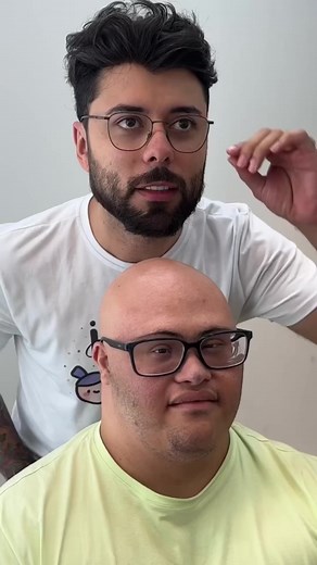 Alopecia Areata em Crianças com Síndrome de Down
