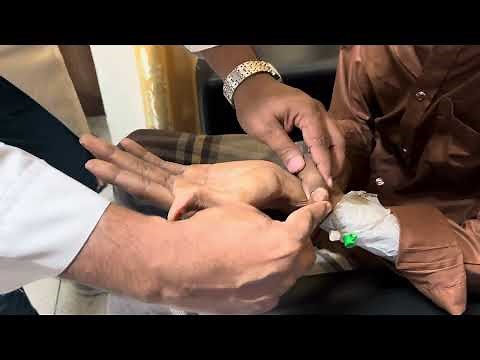 Marfan syndrome Clinical signs in real patient