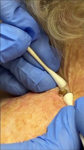 SATISFYING Pore of Winer Removal | Dr. Derm