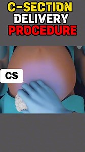 Cesarean section (C-section) is a surgical procedure where a baby is delivered through incisions in the mother's abdomen and uterus, rather than through the vagina. It's a common delivery method, especially when vaginal birth is deemed risky for the mother or baby. C-sections can be planned in advance or may be necessary during labor due to complications. #CS #hospital #cesarianmom #csection #mother #baby #pregnancy #labor #delivery | Midwife Joana