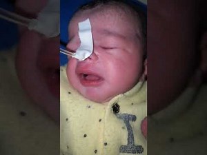 Newborn NG Tube Feeding and Gas Relief Safe Feeding Guide for Parents