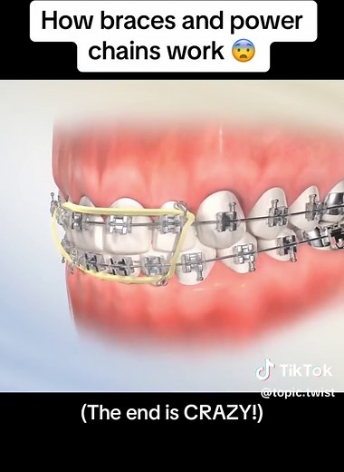 Understanding Power Chains in Braces: Pain and Process Explained