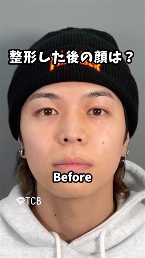 【二重整形】整形した後の顔は？#shorts