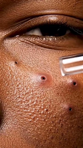 Extreme Blackheads Extraction – Super Close-Up! | Dr. Wellness MD