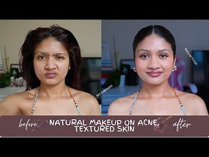 How I Do Natural Makeup on Acne, Dark Spots & Textured Skin | Everyday Routine
