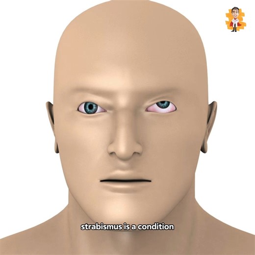 47K views · 428 reactions | This is how eye surgery for Squint Eyes is performed. #Surgery #Medical #Strabismus | Doctor ASKY | Facebook