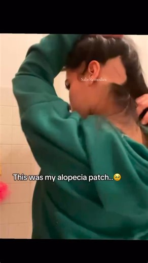 She noticed an alopecia patch and felt her confidence fade… 💔 But after using Sabr Remedies, her hair began to grow back naturally. 🌿✨ No chemicals. No side effects. Just pure ingredients that heal from the roots. 💧 Now, her confidence and her hair are both thriving. 💫 Comment “how to order” below and we’ll guide you through your healing journey. 🛒 #Alopecia #HairRegrowth #SabrRemedies #NaturalHealing #HairCare #ConfidenceRestored #HairOil | Sabr Remedies