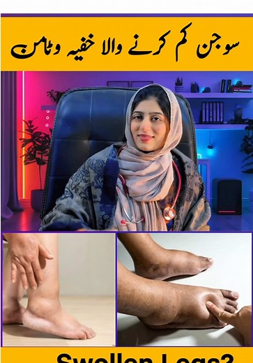 Effective Remedies for Swollen Legs and Water Retention