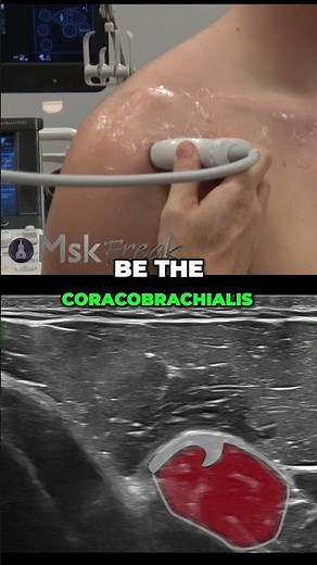 Short head of the biceps ultrasound anatomy