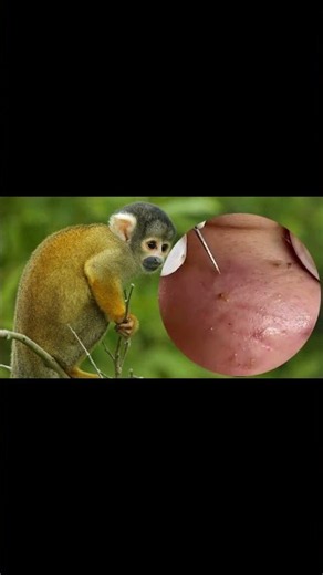 Removing Acne Blackheads on skin, cleaning everywhere