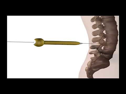 CoreLink Tiger MIS Spine System