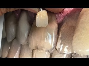 The Perfect Shade Match | Dental Lab Learning