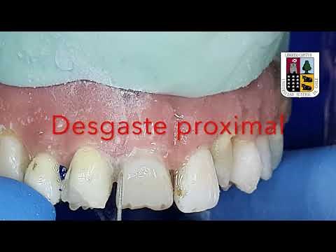 Preparación para prótesis fija anterior