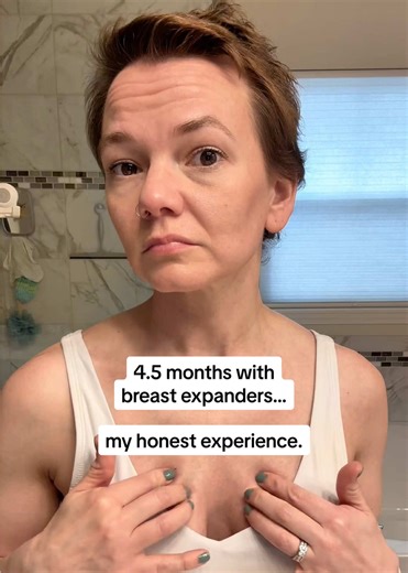 My Honest Experience with Breast Expanders After 4.5 Months