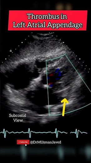 Thrombus in LAA (Left Atrial Appendage) Echocardiography For Beginners