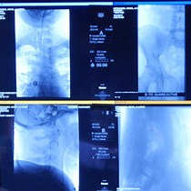 Video: Comprehensive Endovascular and Open Surgical Management of Cerebral Arteriovenous Malformations
