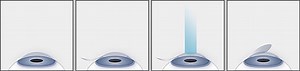 Intralase/Blade Free LASIK - Eye Care Surgery Center