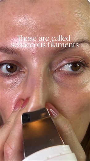 Quickly Remove Sebaceous Filaments with Ultrasonic Spatula