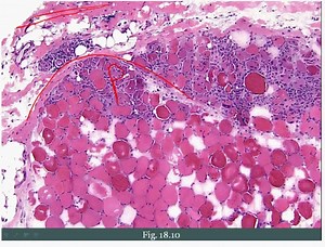 Pathoma - 18. Musculoskeletal Pathology