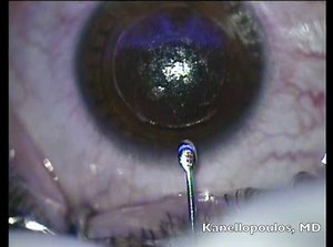 Small Lenticule Extraction - Eyetube