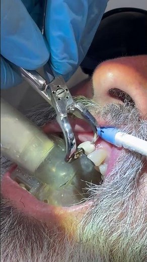 Clinical Crown Removal in Action | Case # 1