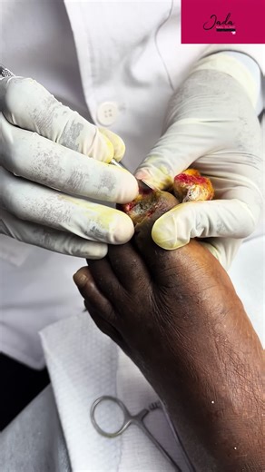 Nail Restoration After Injury: Expected Results