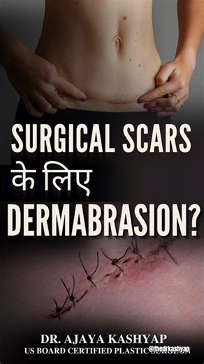 Surgical Scars के लिए Dermabrasion? | Benefits, Results & Recovery #dermabrasion #shorts