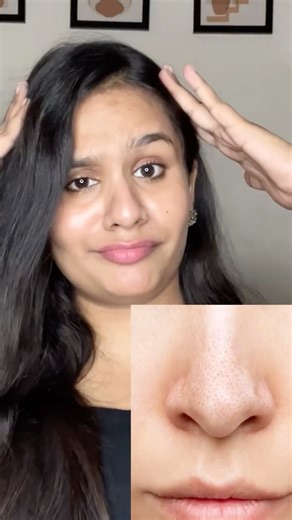 No More Blackheads! Best Way to Use Nose Strips for Blackheads & Whiteheads | Deep Pore Cleaning