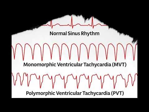 𝔼𝕂𝔾: Ventricular Rhythm, types : 𝕜𝕖𝕪 𝕡𝕠𝕚𝕟𝕥𝕤 𝕥𝕠 𝕚𝕕𝕖𝕟𝕥𝕚𝕗𝕪 #pvc #ventricularrhythm #𝔼𝕂𝔾 #𝕖𝕔𝕘 #𝔼ℂ𝔾