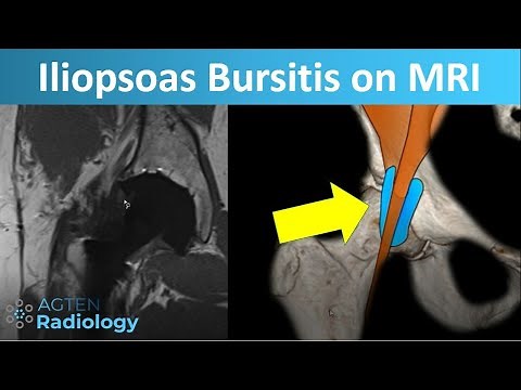 MRI of the Iliopsoas Bursitis and Its Pitfalls