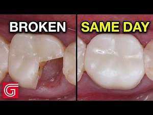 SAME-Day Zirconia Crown: Fracture to Final in ONE Visit