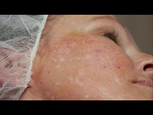 Camouflaging scars with micro-pigmentation