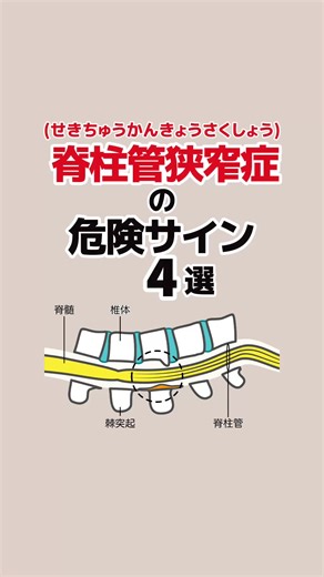 脊柱管狭窄症の危険サイン4選