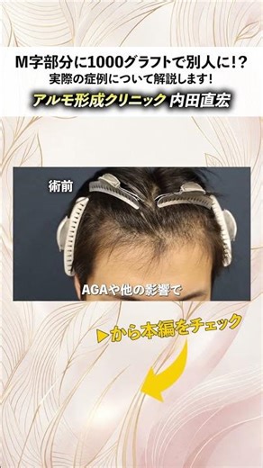 [20s with receding hairline] The clinic director explains a case where 1000 grafts transformed th...