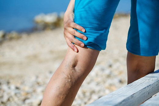 Les 4 symptômes d'une thrombose veineuse (un caillot bouche une veine)