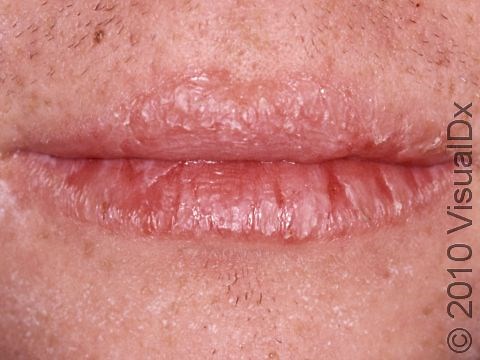 Cheilitis: Causes, Treatment, and Prevention