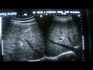 ultrasound of normal vs mild coarsese echogenic liver 2 0f 2